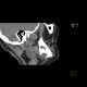 Follicular cyst, adamantinoma: CT - Computed tomography